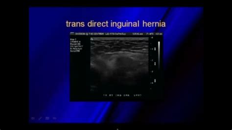 Ultrasound Of Hernias Ultrasound Pandora Screenshot Desktop Screenshot