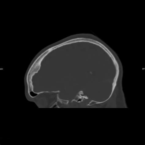 Sagittal Axial And Coronal Ct Images Of The Skull Show Irregular
