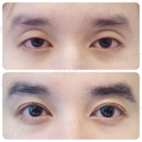 Current Methods Of Double Eyelid Surgery Pros And Cons Inz Clinic