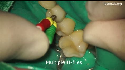 Root Canal Retreatment Gutta Percha Removal Youtube