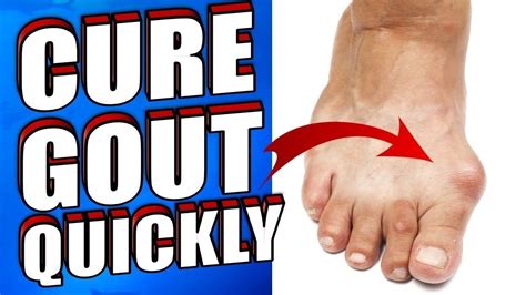 How To Get Rid Of Gout Naturally In 24 Hours Youtube Gout Health