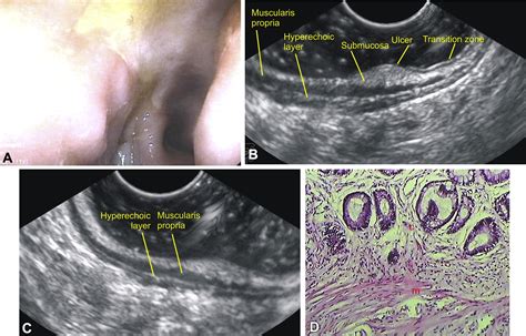 Eus Of Solitary Rectal Ulcer Syndrome Gastrointestinal Endoscopy