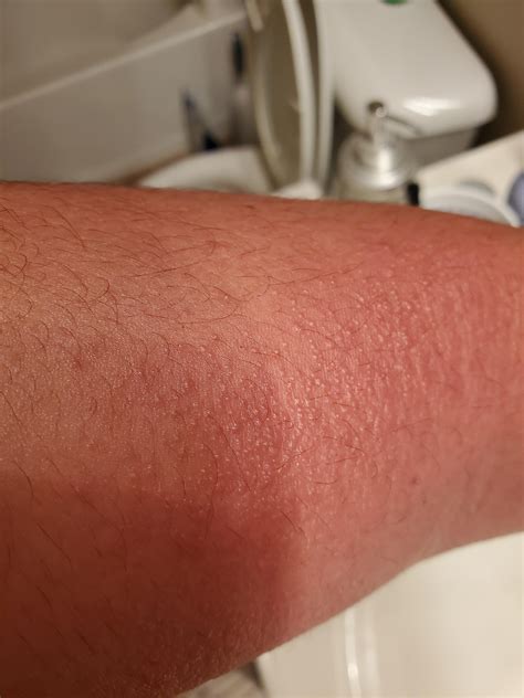 What Is This Red Rash On My Forearm More Details In Comments