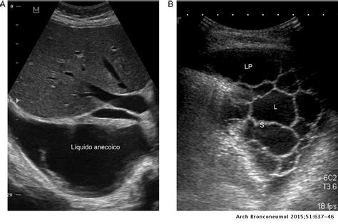 When a blood vessel (a vein or an artery) is injured, the body uses platelets. Manejo del derrame pleural paraneumónico en adultos ...