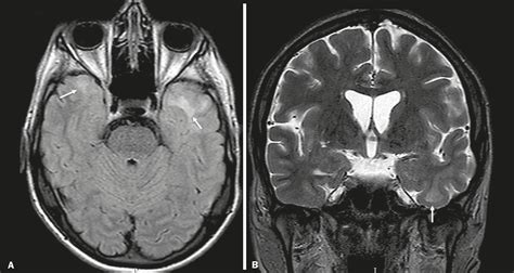 Scielo Brasil Differential Diagnosis Of Temporal Lobe Lesions With Hyperintense Signal On T2