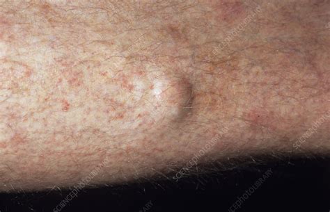 Hernia Stock Image M1700323 Science Photo Library