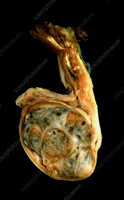 How is testicular cancer treated? Testicular cancer - Stock Image - M865/0309 - Science ...