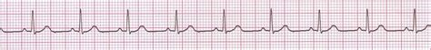 Medical Lecture Notes Online Ecg 3 Normal Sinus Rhythm Nsr