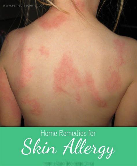 Home Remedies For Skin Allergy Home Remedies For Skin Home Remedies