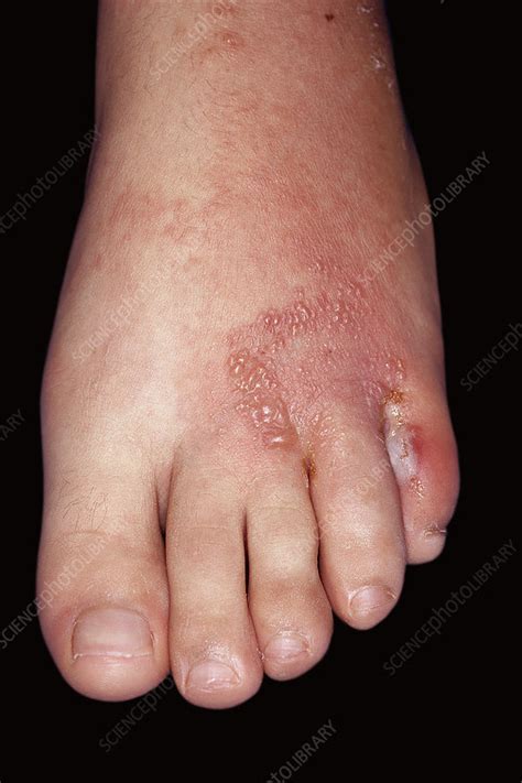 Fungal Infection And Eczema Of The Foot Stock Image C Science Photo Library