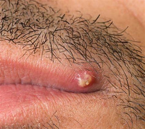 Here are pictures, removal, treatment for infected cysts and how to eliminate ingrown hair roots cysts naturally. Ingrown hair infection causes1 - Treat n Heal