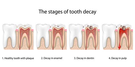 Tooth Decay Is The Result Of An Infection With Certain Types Of