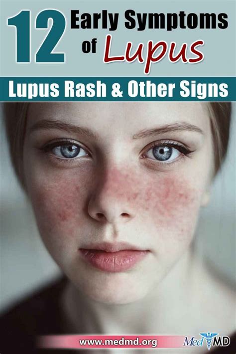 Early Symptoms Of Lupus Lupus Rash Other Signs