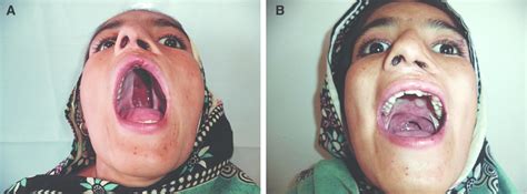 A A 16 Year Old Girl With Unilateral Complete Cleft Palate On Left