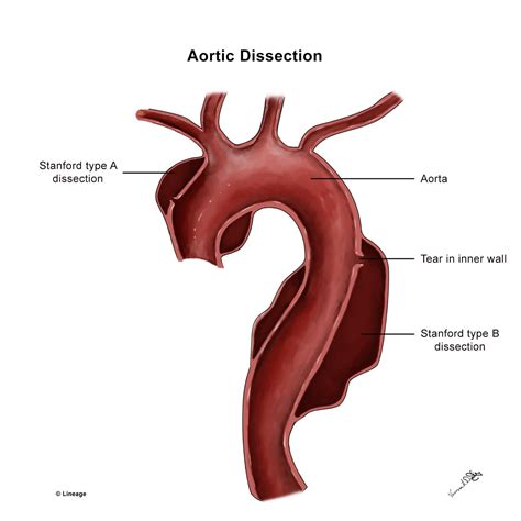 Schematic Illustrations Of Aortic Arch With A Aneurysm B Surgery My