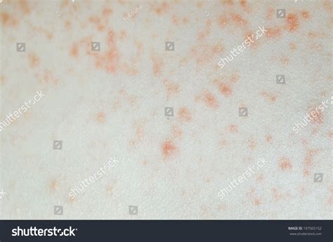 Ill Allergic Rash Dermatitis Eczema Skin Stock Photo 197565152