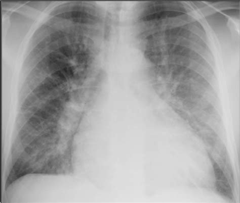 Pulmonary edema is an abnormal buildup of fluid in the lungs. MBBS Medicine (Humanity First): Chest radiograph of ...