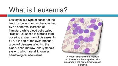 Leukemia Causes Symptoms Types Diagnosis And Treatment