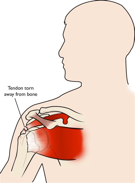 In Front Of You Correlate Penny Rotator Cuff Tear Shoulder Blade Pain