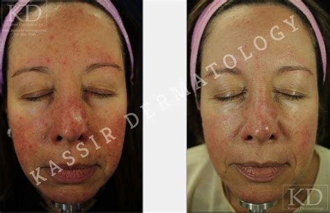 Benefits Of Ipl Treatments Kassir Dermatology Cosmetic Dermatologist