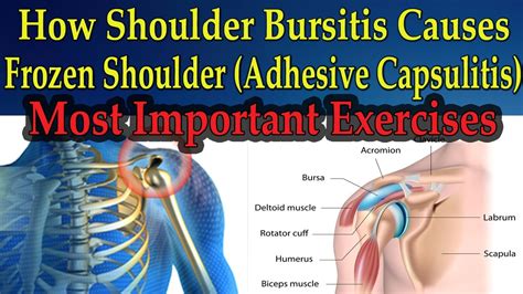 How Shoulder Bursitis Causes Frozen Shoulder Most Important Exercises Dr Mandell Youtube