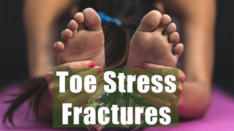 Stress Fractures In The Toes From Running Youtube