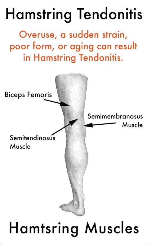 In some cases, tight hamstrings might occur with other symptoms, such as. Hamstring Tendonitis Symptoms and Treatment - Medical Wave