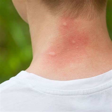 10 Trucos Para Aliviar Las Picaduras De Los Mosquitos Fácilmente