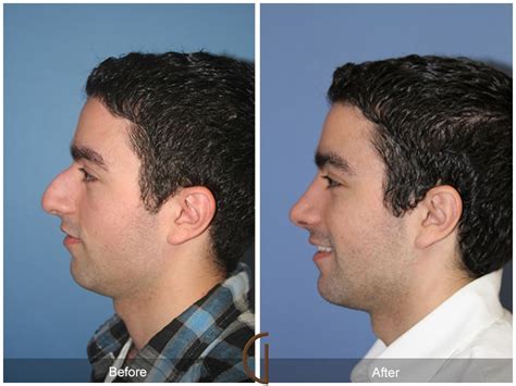During your preoperative consultation, we will give you some nose drops to open up the nose after surgery. Orange County Newport Beach Male Rhinoplasty 58
