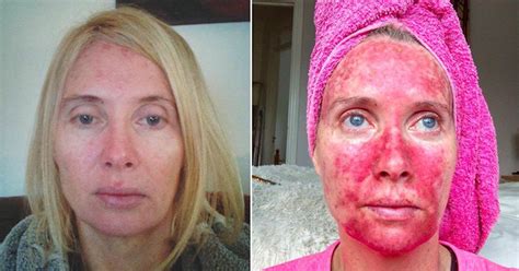 Womans Before And After Pics Show Treatment Post Tanning