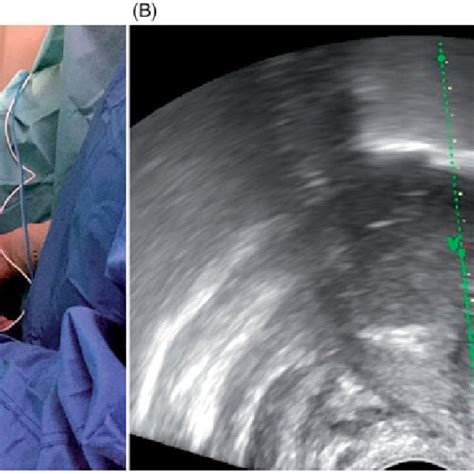 pdf ultrasound guided transvaginal radiofrequency ablation of uterine my xxx hot girl
