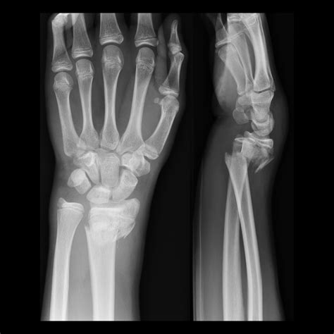 Pediatric Colles Fracture Pediatric Radiology Reference Article