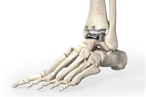 Ankle Replacements Take Off As Devices Appear Durable Wsj