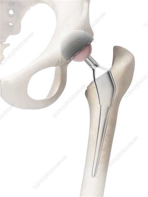 Human Hip Replacement Artwork Stock Image F009 6891 Science Photo Library
