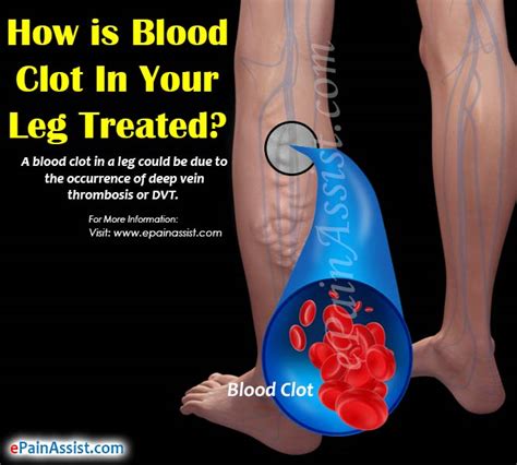 Early Blood Clot Symptoms Know The Risks Signs And Symptoms Of Blood