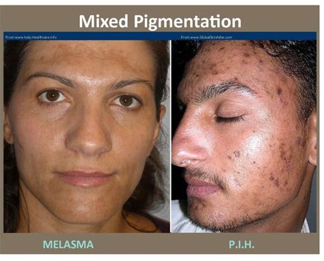 Skin Pigmentation Treatment Plano Tx Top Dermatologist Frisco