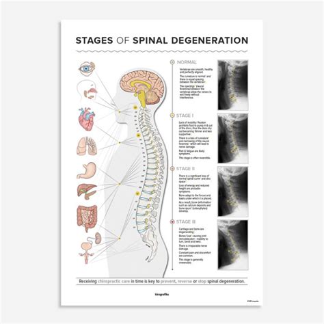 The Stages Of Spinal Degeneration Poster Kirografiks