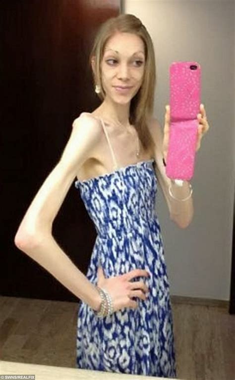 Anorexic Whose Weight Plummeted To 4st Came Back From Brink Of Death