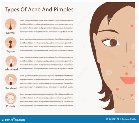 Types Of Acne And Pimples Vector Illustration 76957124