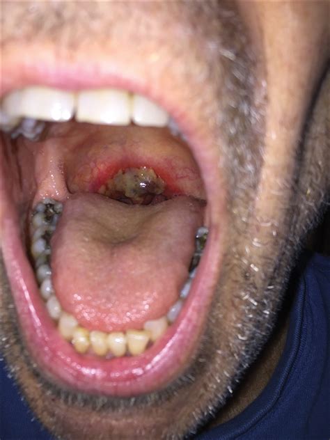 Squamous Cell Carcinoma Mouth