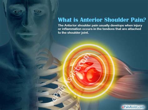What is Anterior Shoulder Pain|Causes|Symptoms|Treatment|Exercise|Diagnosis