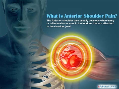 What Is Anterior Shoulder Paincausessymptomstreatmentexercisediagnosis