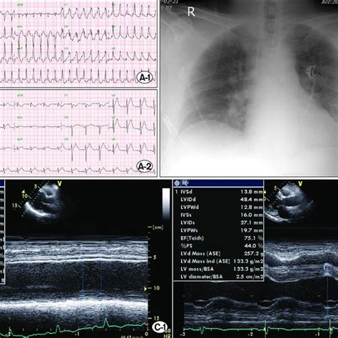 Electrocardiogram Ecg Chest X Ray And Transthoracic Echocardiography