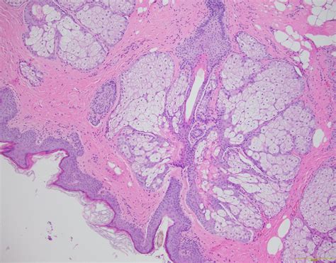 Qiaos Pathology Orbital Dermoid Cyst A Photo On Flickriver