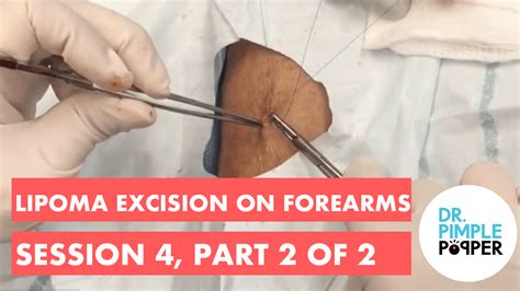 Lipoma Excision On Forearms Session 4 Part 2 Of 2 Lipoma Love Dr