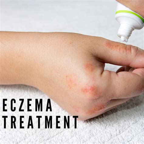 How To Get Rid Of Eczema Bumps On Face Eczema Picture Image On