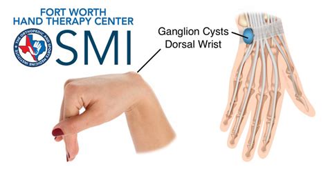 Ganglion Cyst Dorsal Wrist Osmi The Orthopedic And Sports Medicine