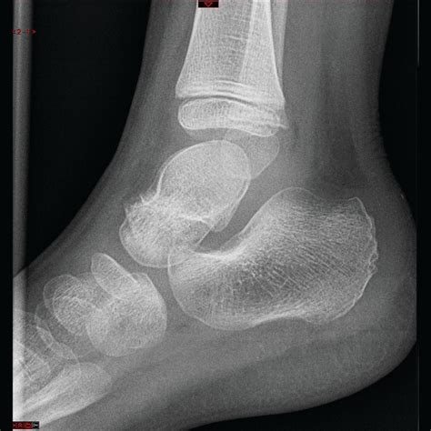 Talus Fracture In A 4 Year Old Child Bmj Case Reports