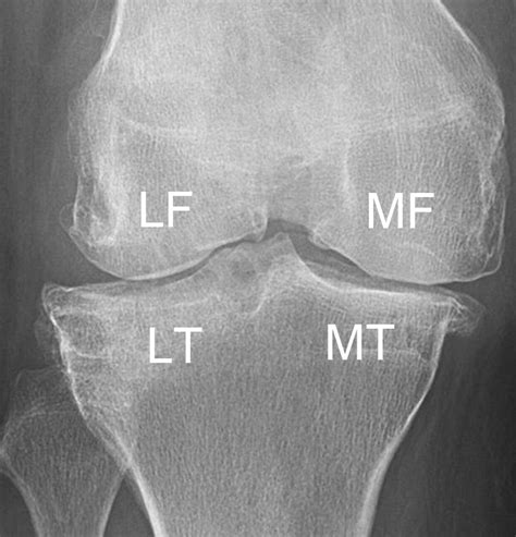 Detection Of Osteophytes And Subchondral Cysts In The Knee With Use Of