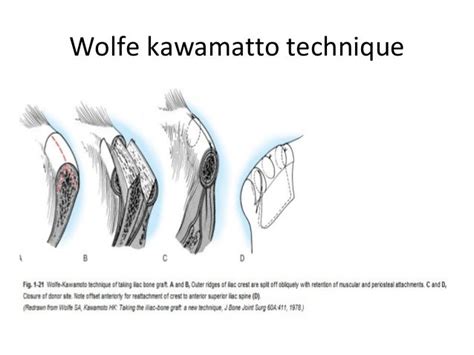Bone grafts and bone grafts substitutes